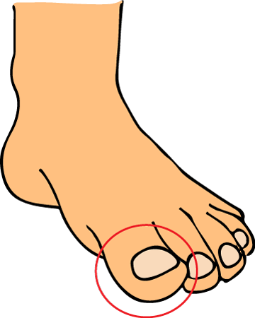 Toe